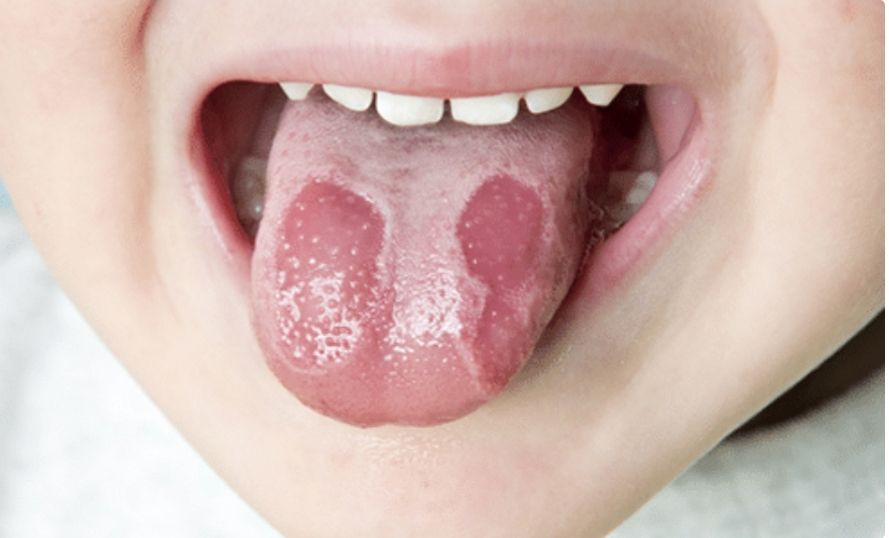 lidah anak bertompok